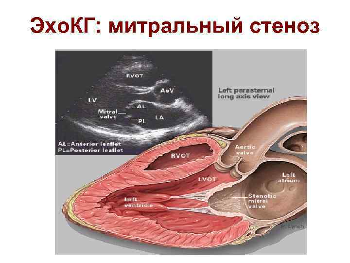 Эхо. КГ: митральный стеноз 