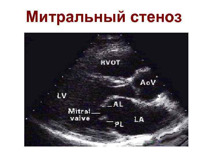 Митральный стеноз 