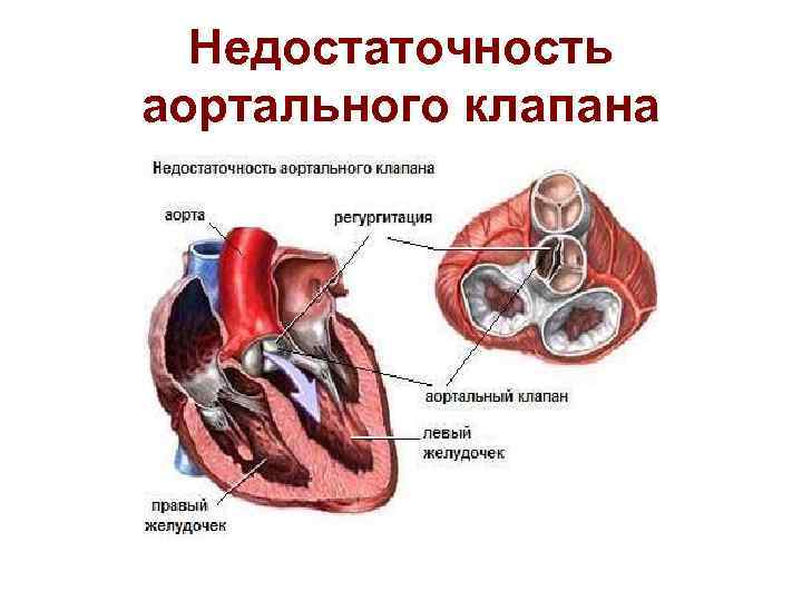 Недостаточность аортального клапана это