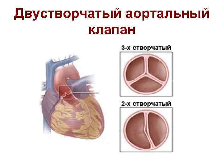 Двустворчатый аортальный клапан 