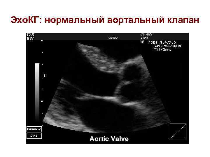 Эхо. КГ: нормальный аортальный клапан 