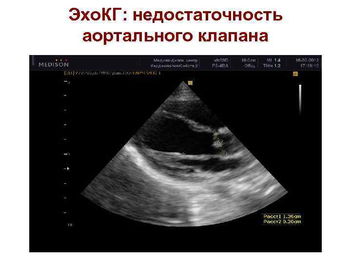 Эхо. КГ: недостаточность аортального клапана 