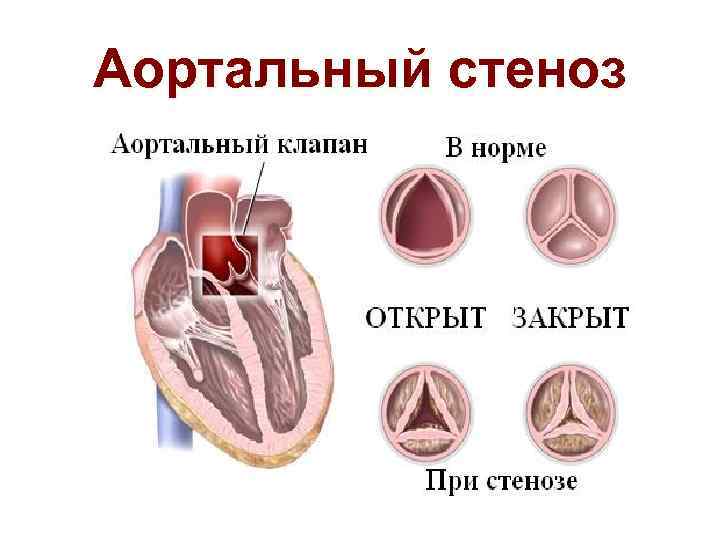 Аортальный стеноз 