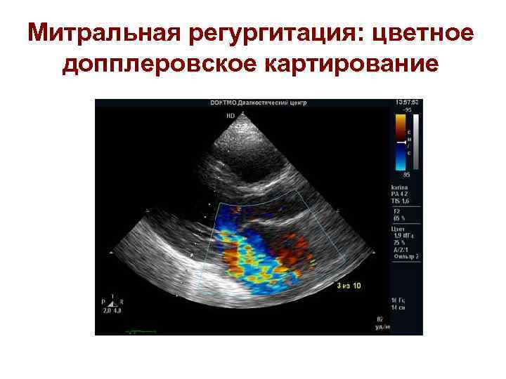 Митральная регургитация: цветное допплеровское картирование 