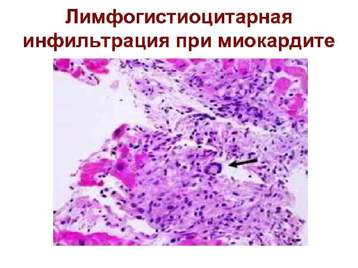 Лимфогистиоцитарная инфильтрация при миокардите 