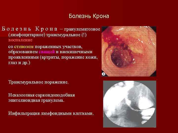 Болезнь Крона Б о л е з н ь К р о н а