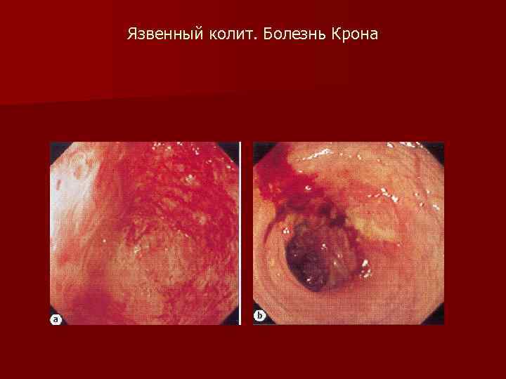 Язвенный колит. Болезнь Крона 