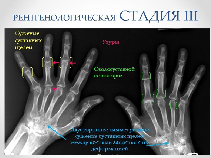 Остеопороз кистей рук фото