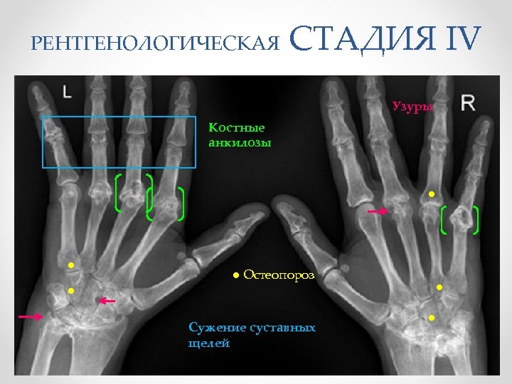 Остеопороз кистей рук фото