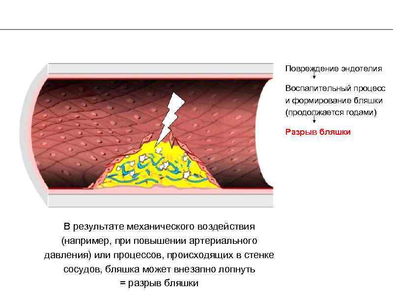 Разрыв бляшки. Повреждение эндотелия. Повреждение эндотелия сосудов. Причины повреждения эндотелия сосудов. Процесс развития атеросклероза повреждение эндотелия.
