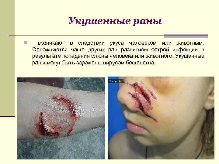 Укушенные раны n возникают в следствии укуса человеком или животным. Осложняются чаще других ран
