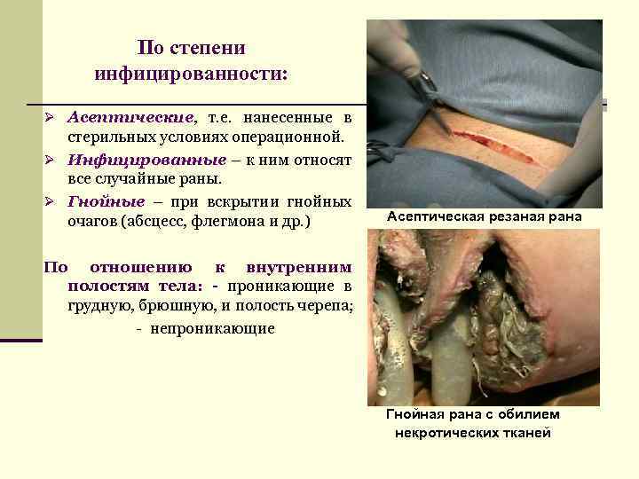 По степени инфицированности: Ø Асептические, т. е. нанесенные в стерильных условиях операционной. Ø Инфицированные