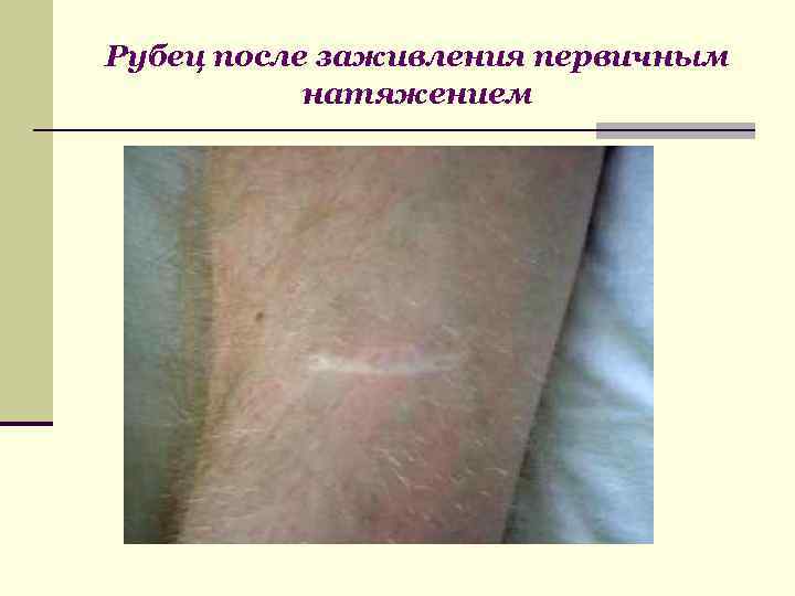 Рубец после заживления первичным натяжением 