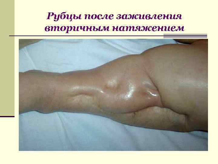 Рубцы после заживления вторичным натяжением 