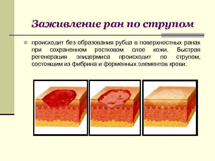 Заживление ран по струпом n происходит без образования рубца в поверхностных ранах при сохраненном