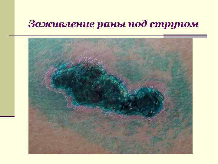 Заживление раны под струпом 