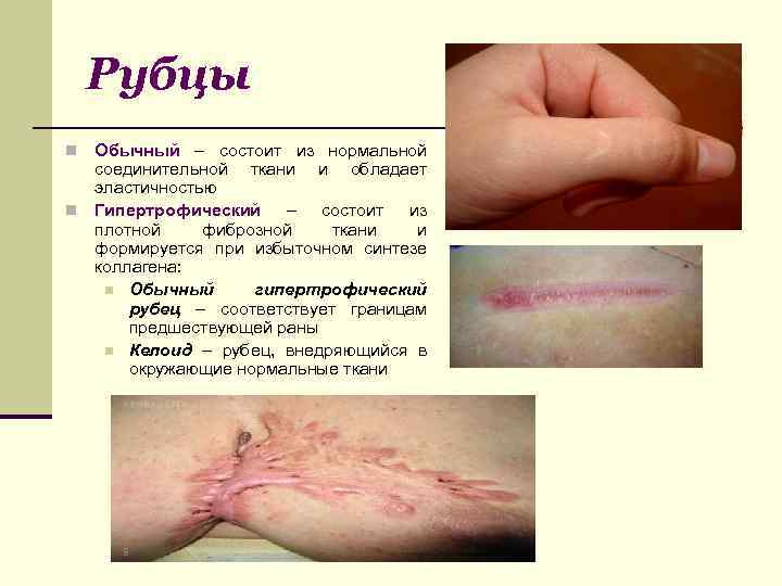 Рубцы Обычный – состоит из нормальной соединительной ткани и обладает эластичностью n Гипертрофический –