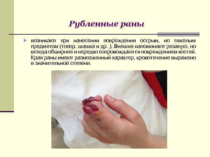 Рубленные раны Ø возникают при нанесении повреждения острым, но тяжелым предметом (топор, шашка и