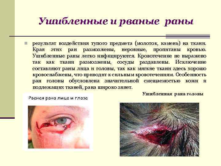 Ушибленные и рваные раны n результат воздействия тупого предмета (молоток, камень) на ткани. Края