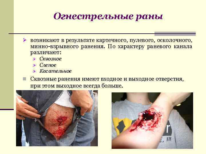 Огнестрельные раны Ø возникают в результате картечного, пулевого, осколочного, минно-взрывного ранения. По характеру раневого