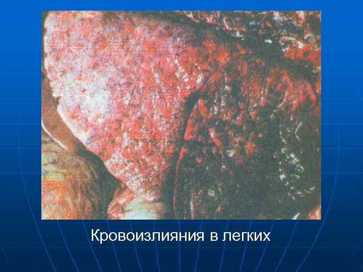 Кровоизлияния в легких 