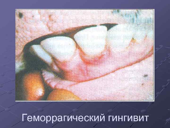 Геморрагический гингивит 