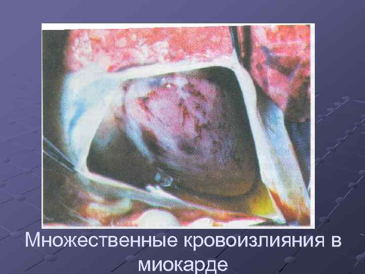 Множественные кровоизлияния в миокарде 