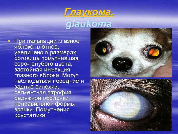 Глаукома. glaukoma § При пальпации глазное яблоко плотное, увеличено в размерах, роговица помутневшая, серо-голубого