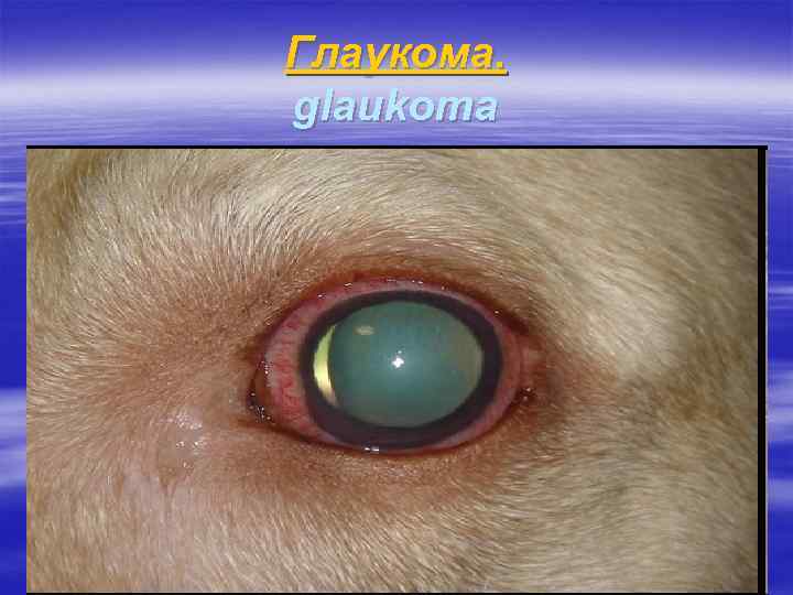 Глаукома. glaukoma 