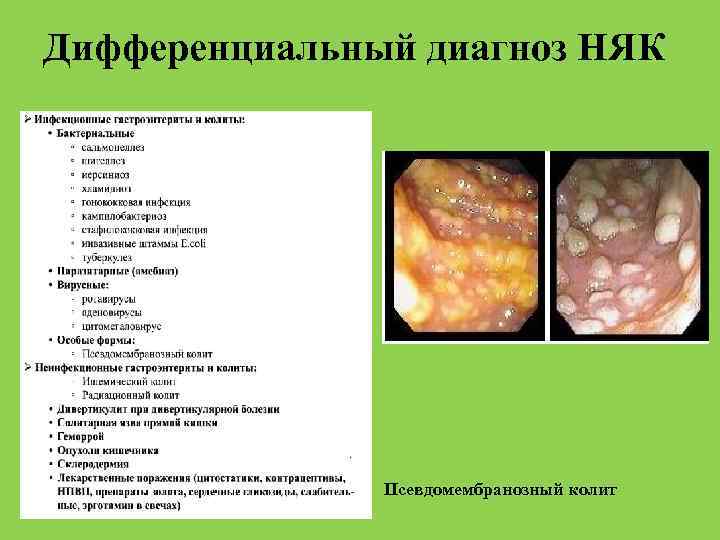 Дифференциальный диагноз НЯК Псевдомембранозный колит 