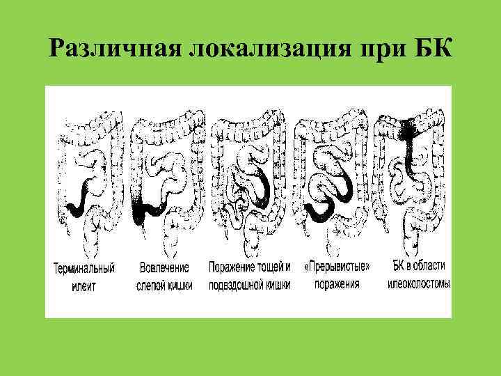 Различная локализация при БК 