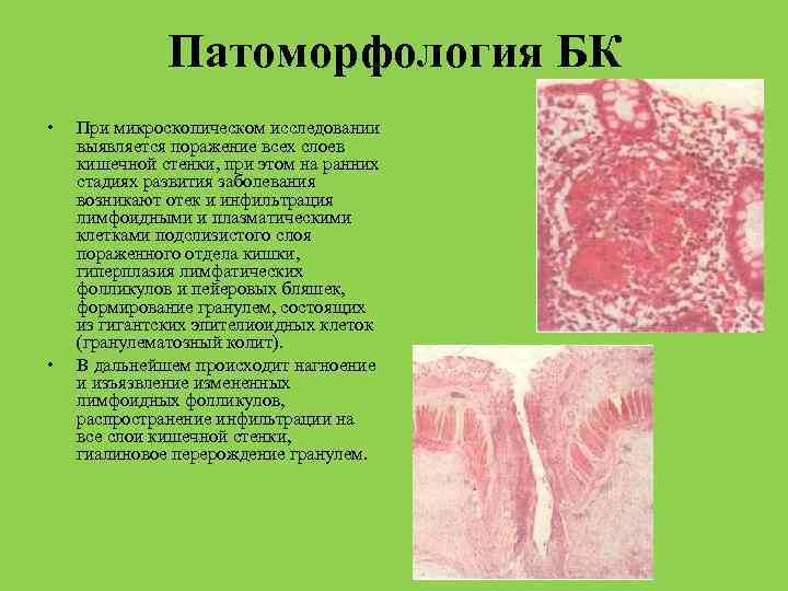 Патоморфология БК • • При микроскопическом исследовании выявляется поражение всех слоев кишечной стенки, при