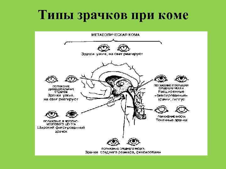 Реакция на свет. Реакция зрачков при коме. Реакция зрачков на свет при коме. Расширенные зрачки при коме.