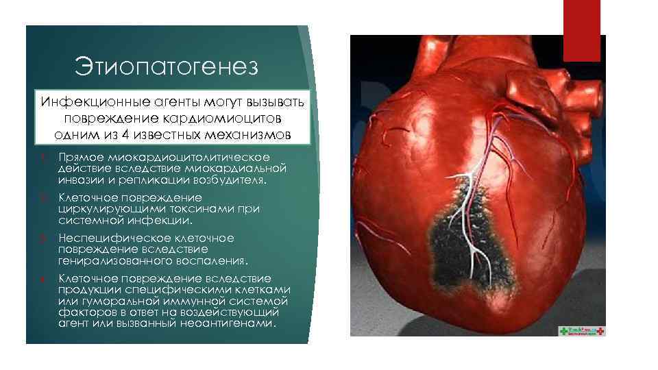 Этиопатогенез Инфекционные агенты могут вызывать повреждение кардиомиоцитов одним из 4 известных механизмов 1. Прямое