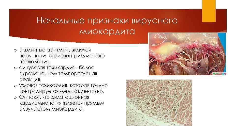 Начальные признаки вирусного миокардита o различные аритмии, включая нарушения атриовентрикулярного проведения. o синусовая тахикардия