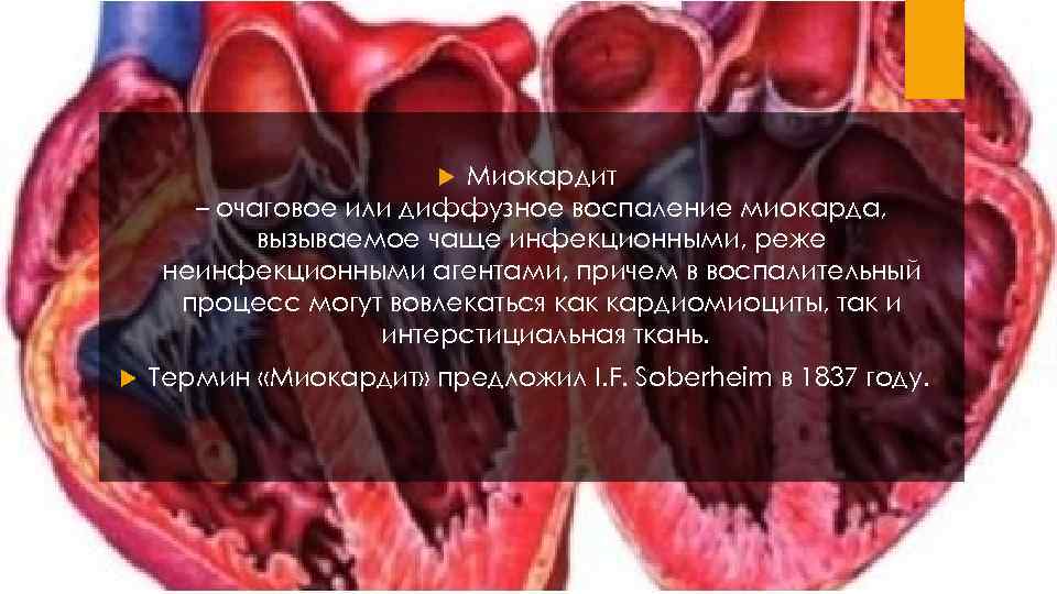 Миокардит – очаговое или диффузное воспаление миокарда, вызываемое чаще инфекционными, реже неинфекционными агентами, причем