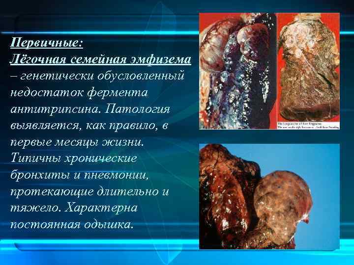 Первичные: Лёгочная семейная эмфизема – генетически обусловленный недостаток фермента антитрипсина. Патология выявляется, как правило,