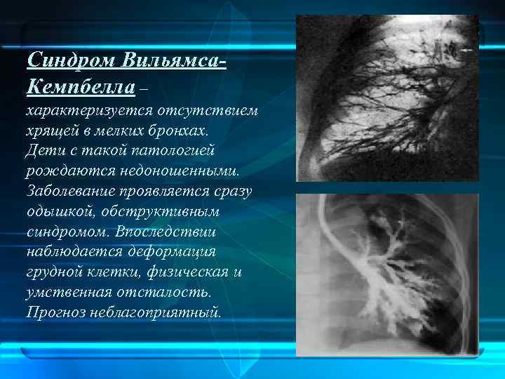 Синдром Вильямса. Кемпбелла – характеризуется отсутствием хрящей в мелких бронхах. Дети с такой патологией