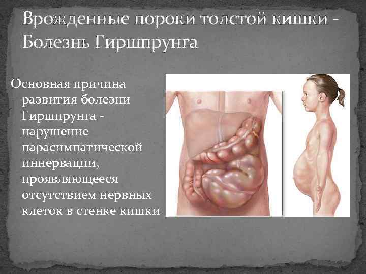 Врожденные пороки толстой кишки Болезнь Гиршпрунга Основная причина развития болезни Гиршпрунга нарушение парасимпатической иннервации,