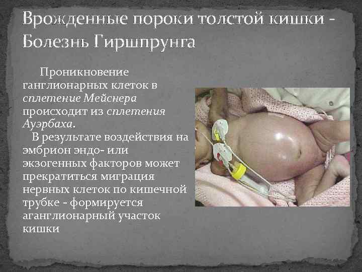 Врожденные пороки толстой кишки Болезнь Гиршпрунга Проникновение ганглионарных клеток в сплетение Мейснера происходит из