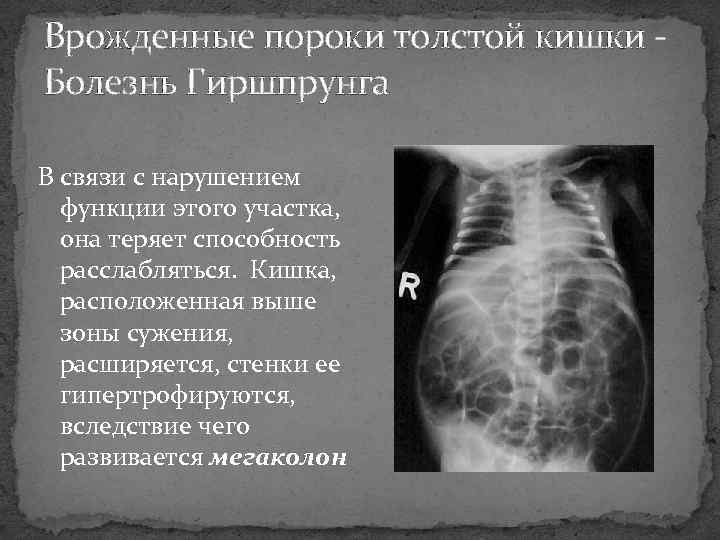 Врожденные пороки толстой кишки Болезнь Гиршпрунга В связи с нарушением функции этого участка, она