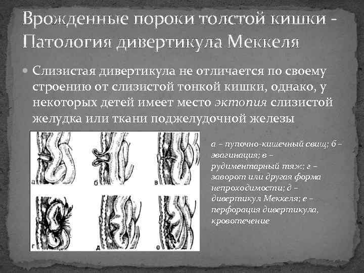 Врожденные пороки толстой кишки Патология дивертикула Меккеля Слизистая дивертикула не отличается по своему строению