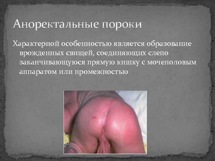 Аноректальные пороки Характерной особенностью является образование врожденных свищей, соединяющих слепо заканчивающуюся прямую кишку с