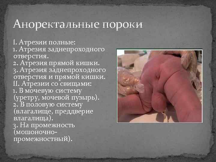 Аноректальные пороки I. Атрезии полные: 1. Атрезия заднепроходного отверстия. 2. Атрезия прямой кишки. 3.