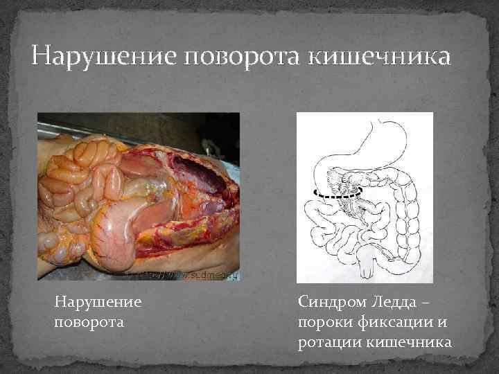 Нарушение поворота кишечника Нарушение поворота Синдром Ледда – пороки фиксации и ротации кишечника 