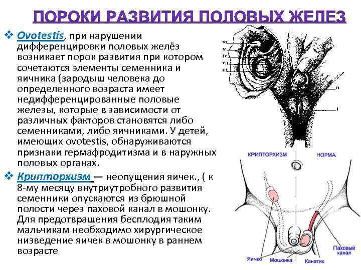 v Оvotestis, при нарушении дифференцировки половых желёз возникает порок развития при котором сочетаются элементы