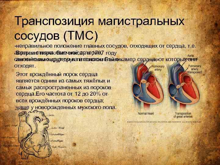 Транспозиция магистральных сосудов (ТМС) -неправильное положение главных сосудов, отходящих от сердца, т. е. аорты