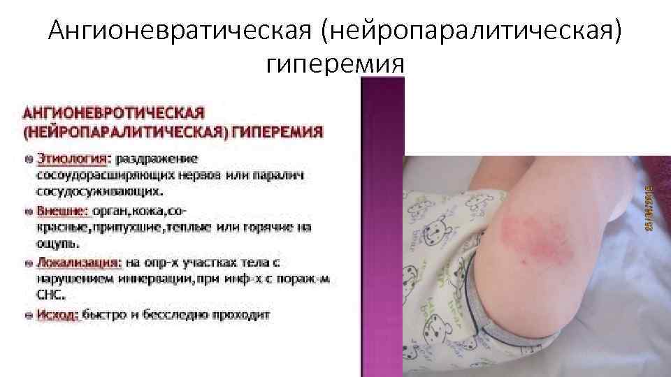 Ангионевратическая (нейропаралитическая) гиперемия 