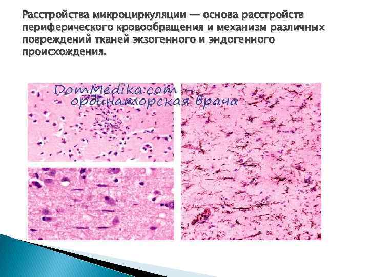 Расстройства микроциркуляции — основа расстройств периферического кровообращения и механизм различных повреждений тканей экзогенного и