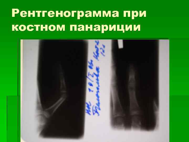 Рентгенограмма при костном панариции 